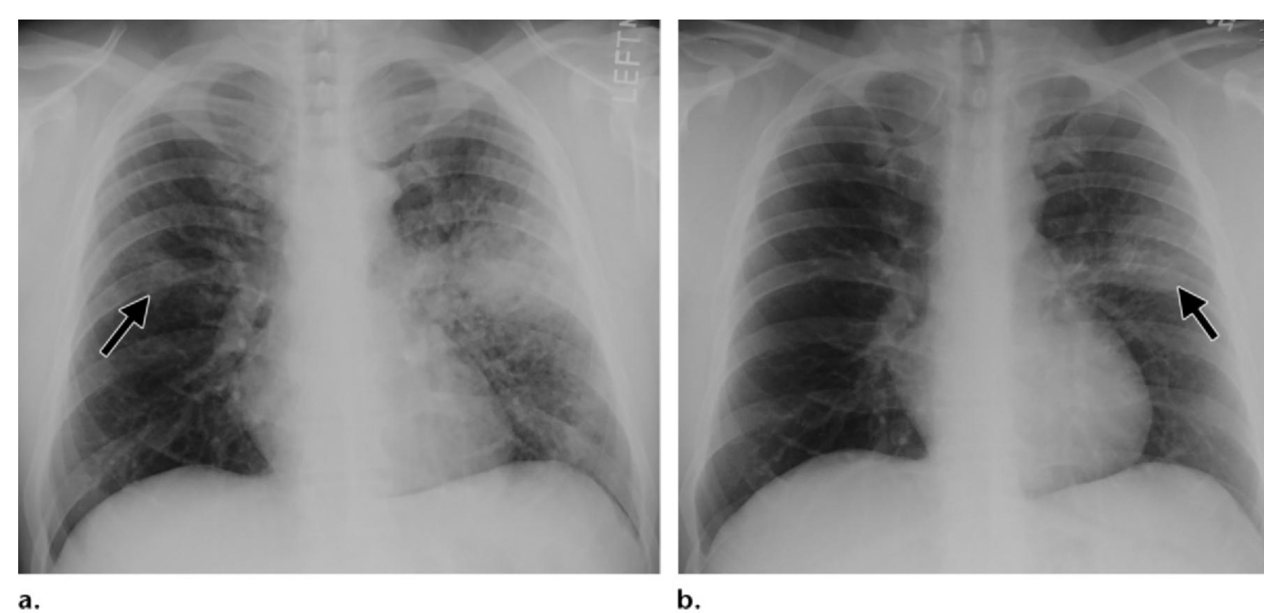 (PDF) Pulmonary Coccidioidomycosis: Pictorial Review of Chest ...