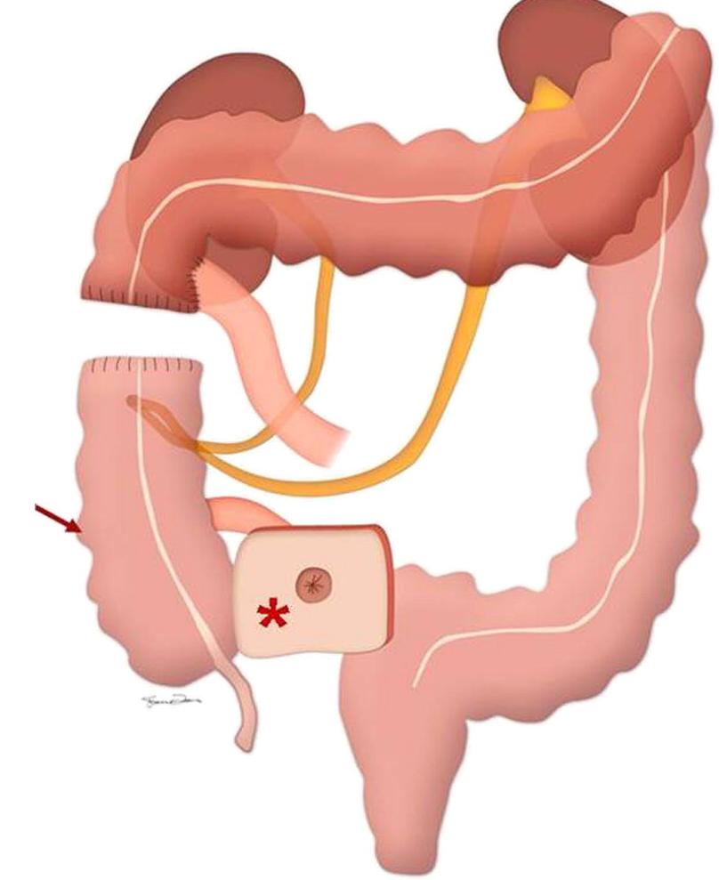 (PDF) Diversion ahead: imaging appearance of urinary diversions and ...