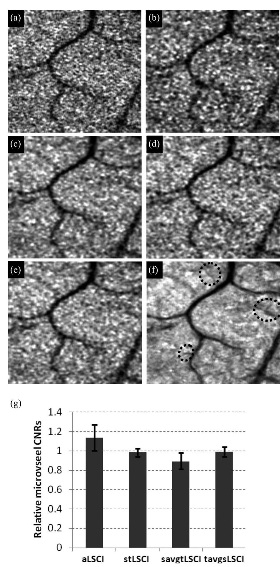 (PDF) Anisotropic Processing of Laser Speckle Images Improves ...