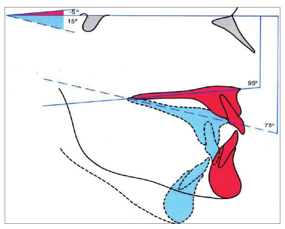 Maxillary Plane Rotation (PDF) Assessment of the relationship between maxillary rotation and ...