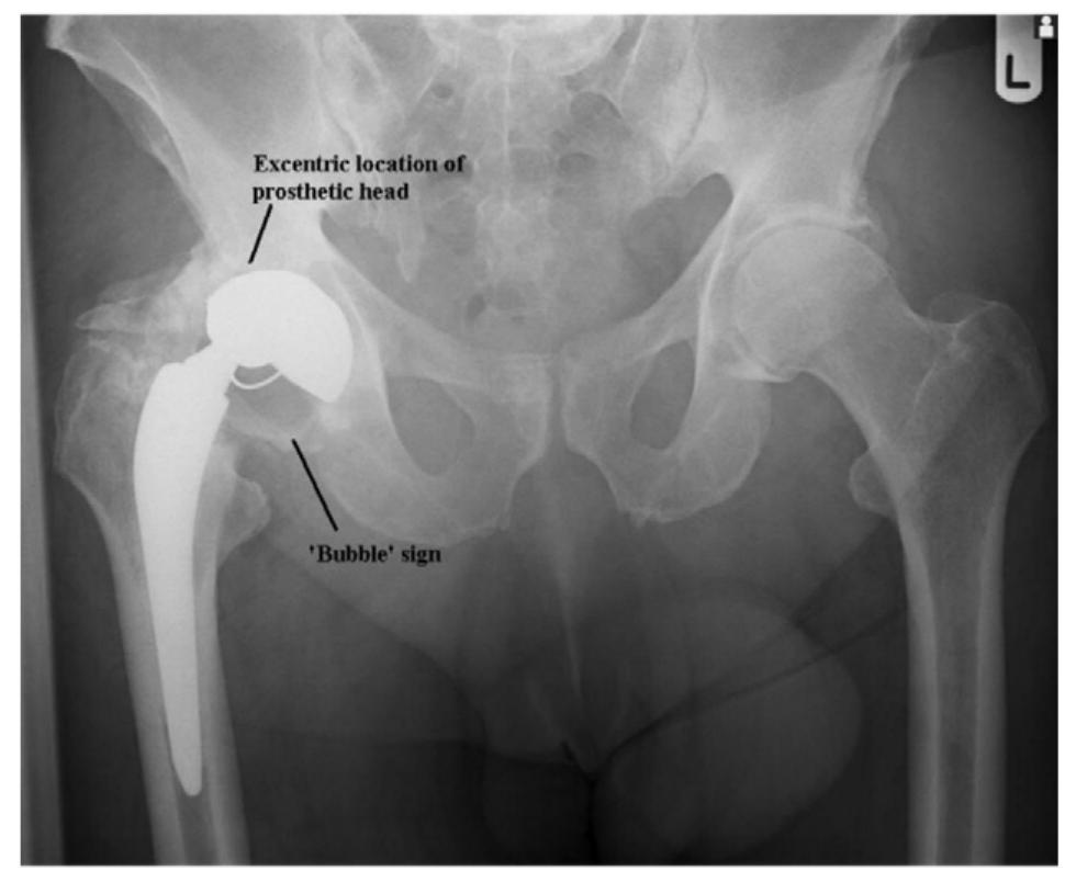 Retrieved prosthesis showing full-thickness erosion of the