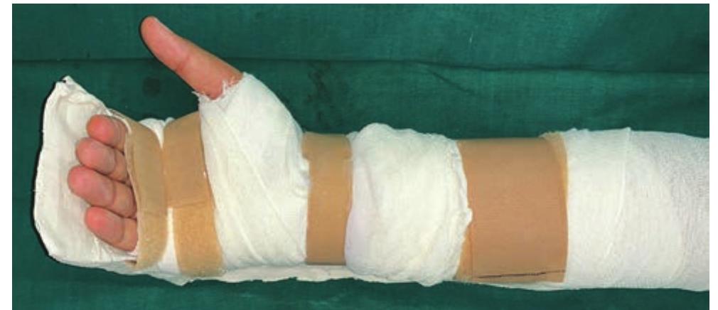 Figure 2 - from Velcro Straps as A Convenient Alternative to