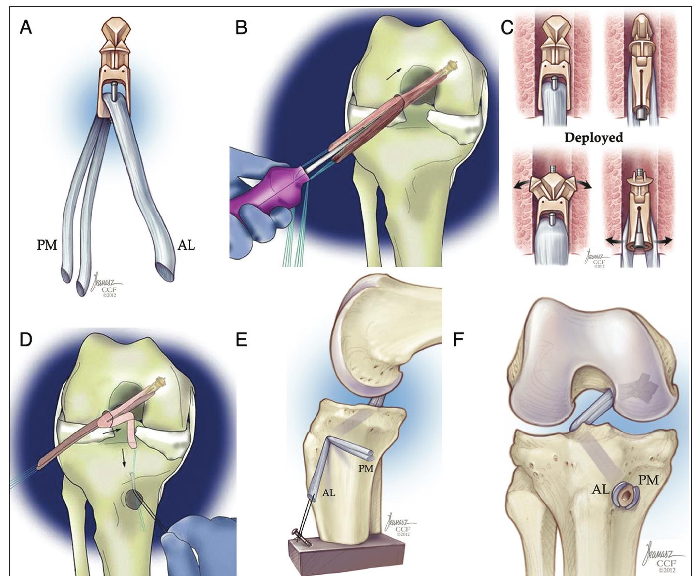 Schematic drawing of the posterior cruciate ligament