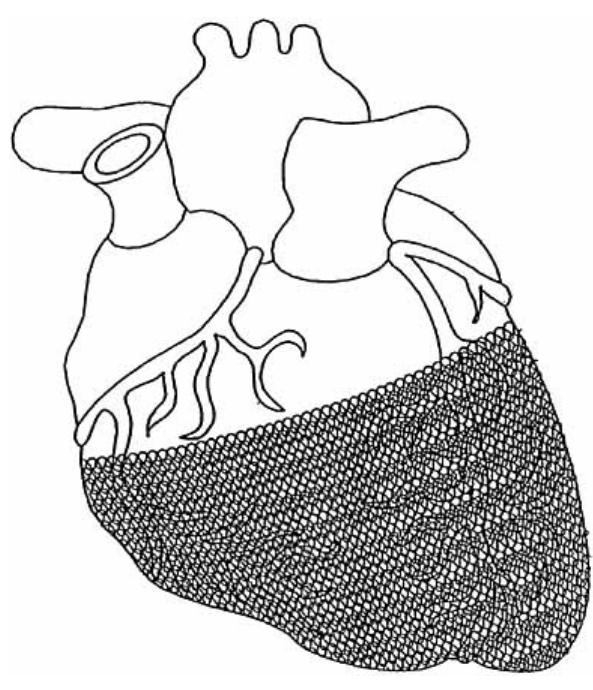 (4). perspective view of a cardiac hamess made from a matrix