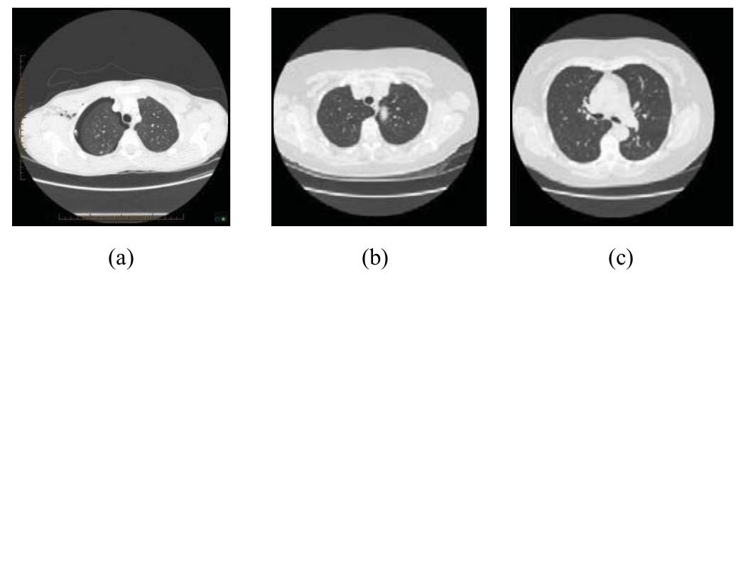 (PDF) Automatic Lung Segmentation in HRCT Images