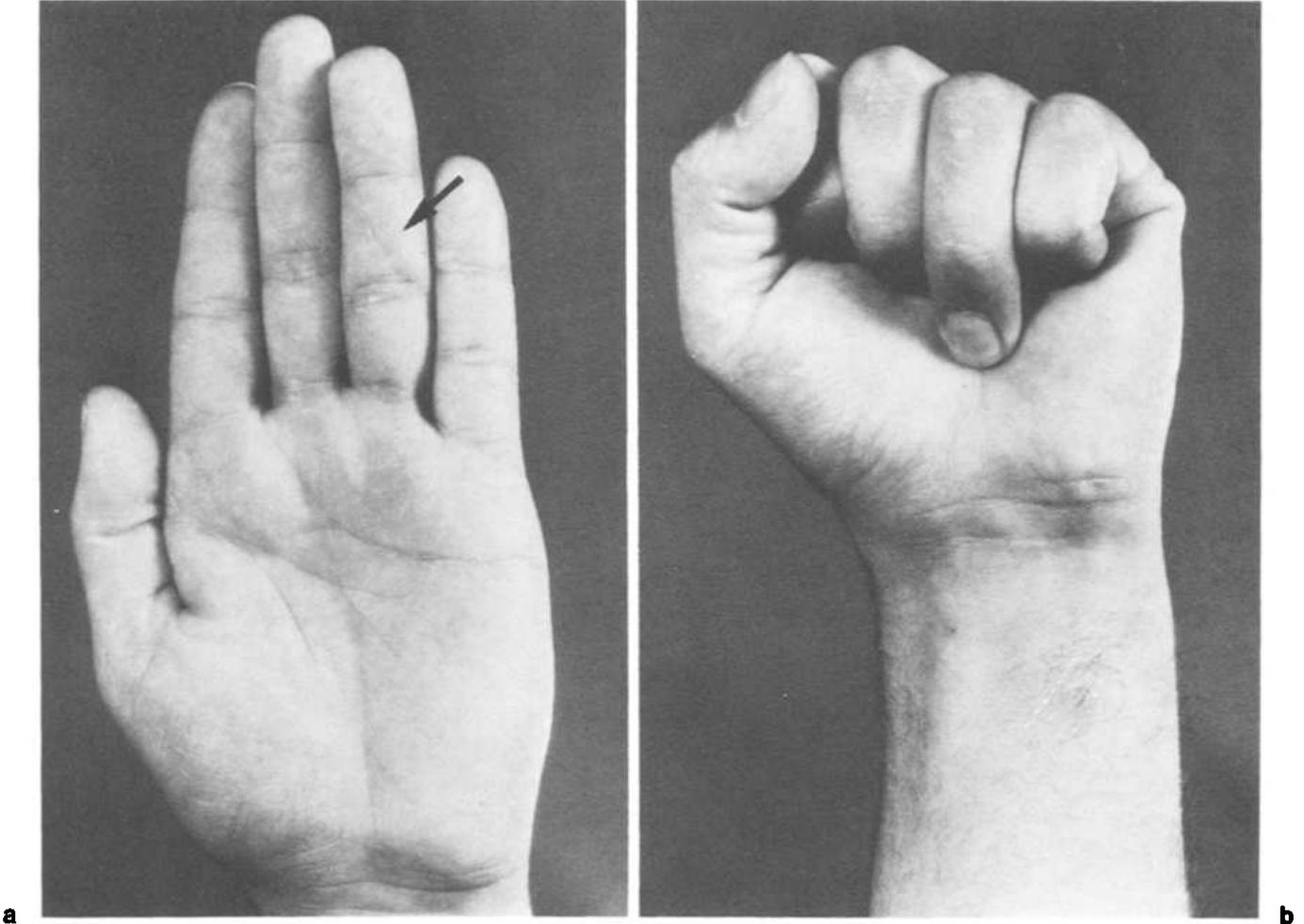 A et b. — main gauche du patient (homme 29 ans) 16 semaines