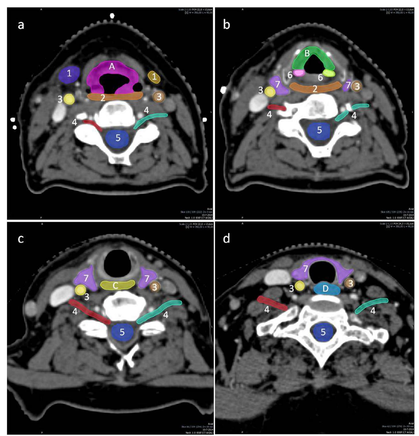 (PDF) CT-based delineation of organs at risk in the head and neck ...