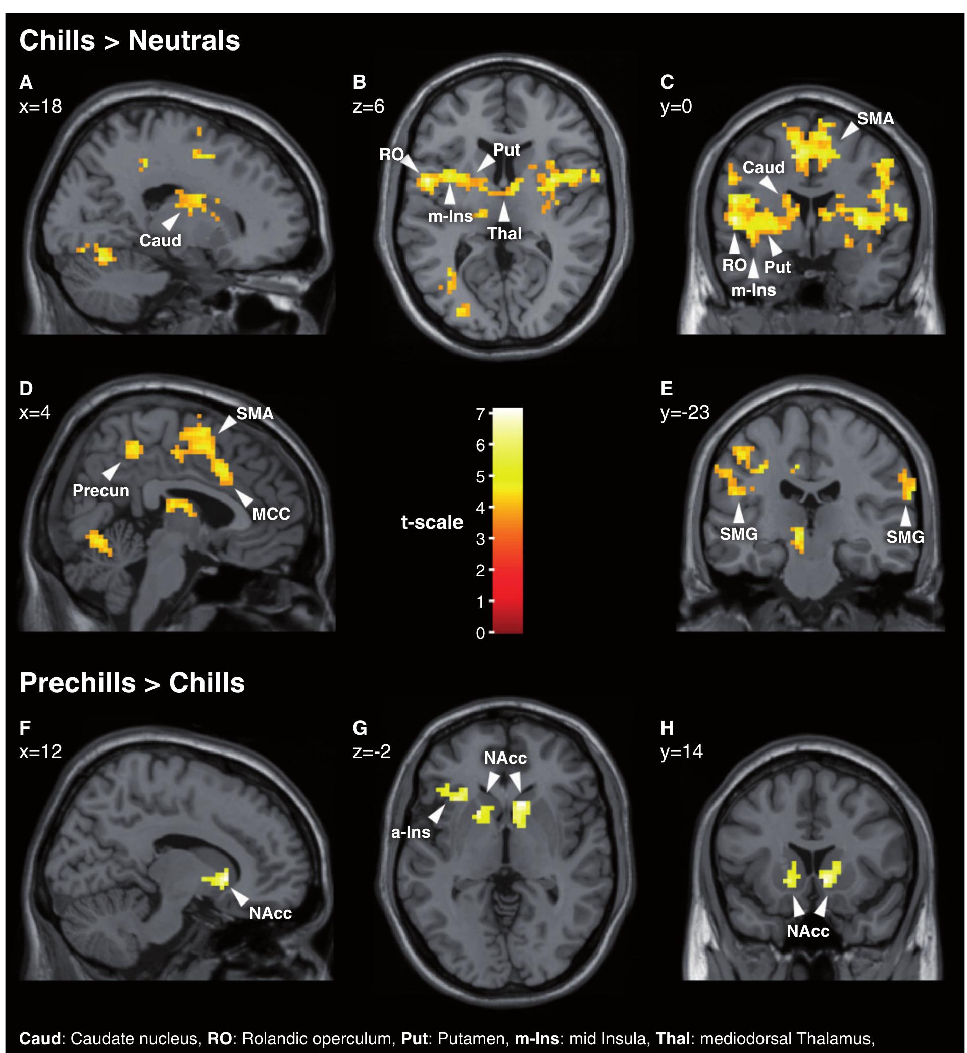 Fig. 3. Whole-brain statistical parametric maps for two contrasts: Chills > Neutrals. Chill-specific activations recruit the mesolimbic circuitry of primary reward pro cessing (caudate nucleus, putamen and mediodorsal thalamus). Prechills > Chills. A contrast of the prechill (reward anticipation) with the chill (reward attainment shows significant bilateral activations during the anticipation in the ventral striatum, including the nucleus accumbens, thus emphasizing its role in preparing the aes thetic peak. (A, D, F) Sagittal views of the right hemisphere; (B, G) Axial views; (C, E, H) Coronal views (for readability, bilateral activations in B and C are labeled on onl; one side). SPMs are plotted on the average high-resolution anatomical image, displayed in neurological convention (left hemisphere on the left); the coordinates refe to MNI space; only clusters significant at P< 0.05, FWE-corrected, are shown. 