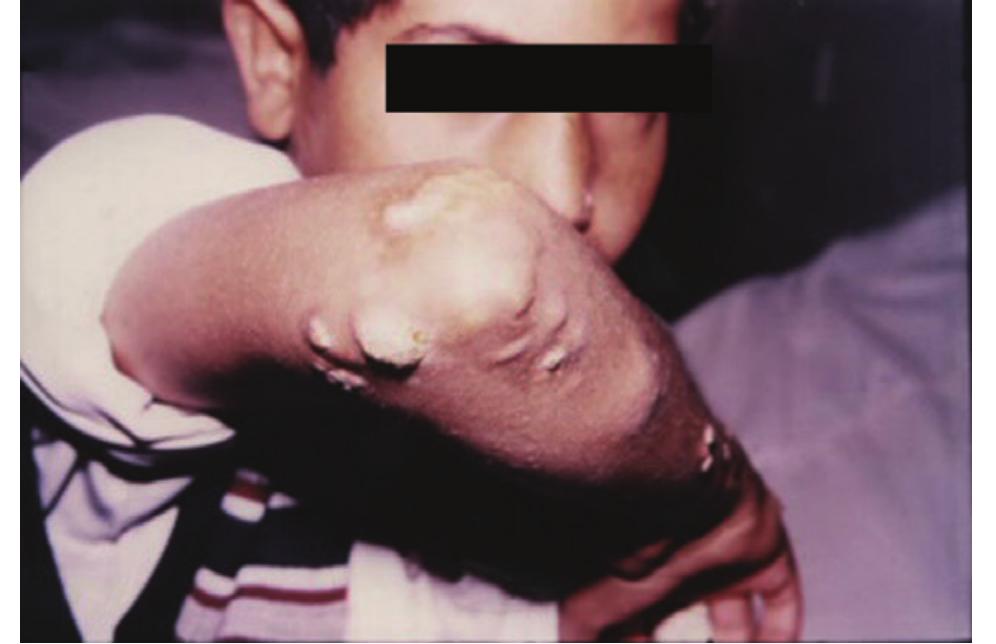 (PDF) Diffuse cutaneous calculi (subepidermal calcified nodules): case ...