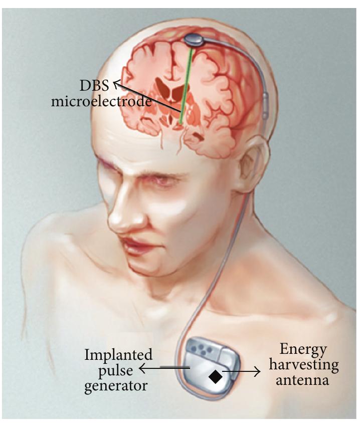 Ficure 1: a typical dbs system with an energy harvesting