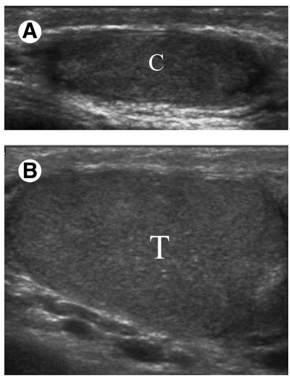 Thiasis (PDF) Ultrasound of the scrotum