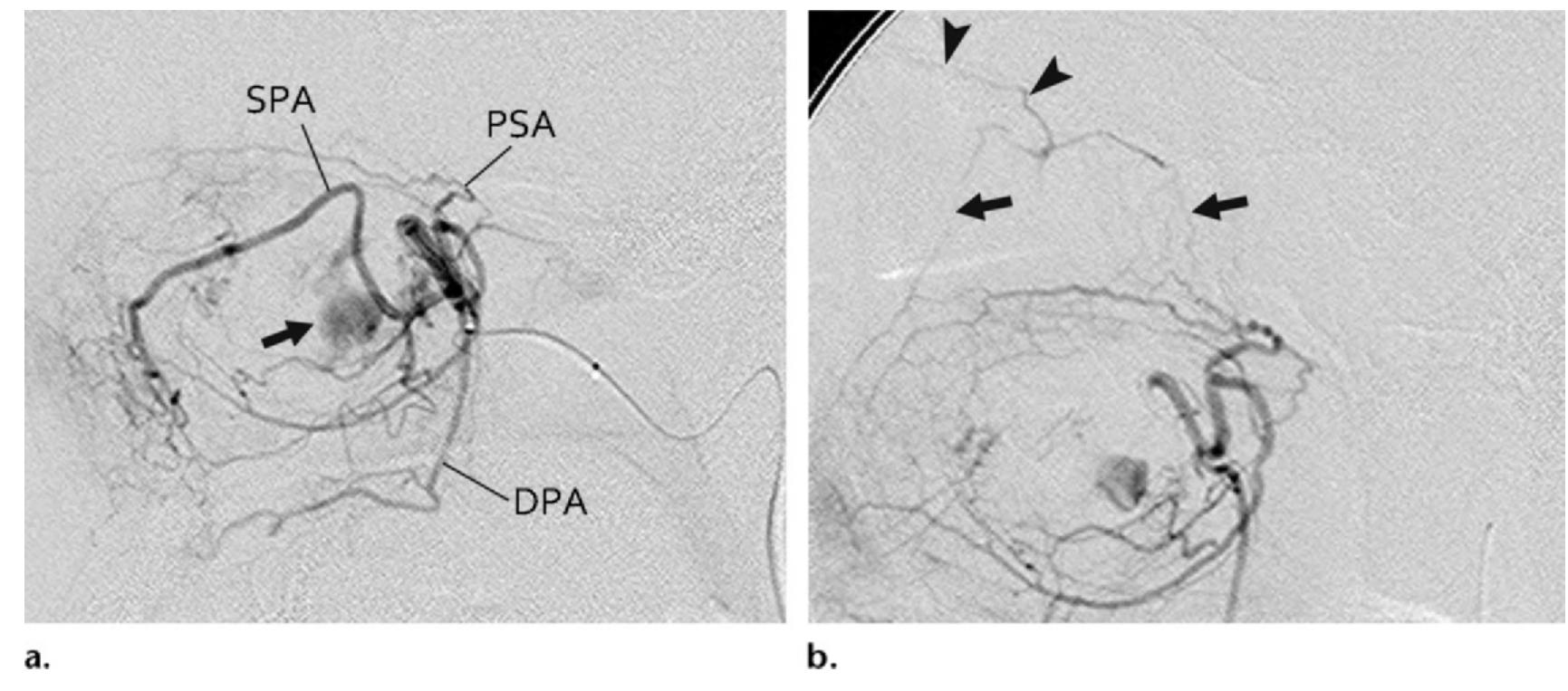 Spa Embolization (PDF) Maxillary Artery: Functional and Imaging Anatomy for Safe and ...