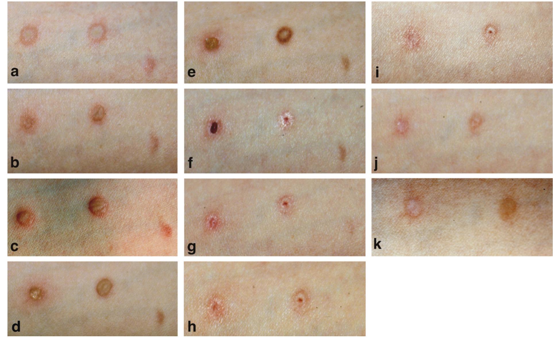 cigarette burns healed PDF) Cigarette burns in forensic medicine
