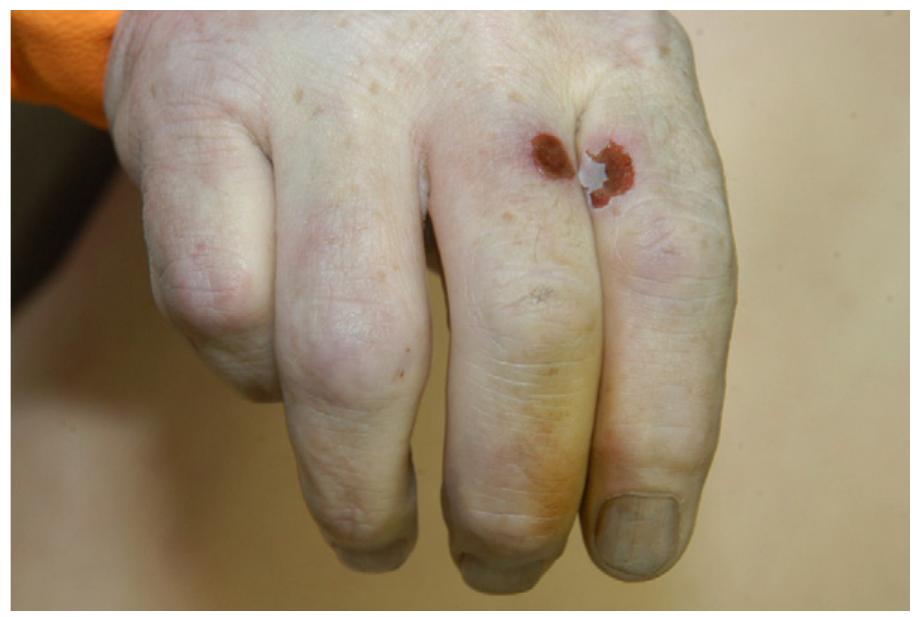 skin condition that looks like cigarette burns PDF) Cigarette burns in forensic medicine