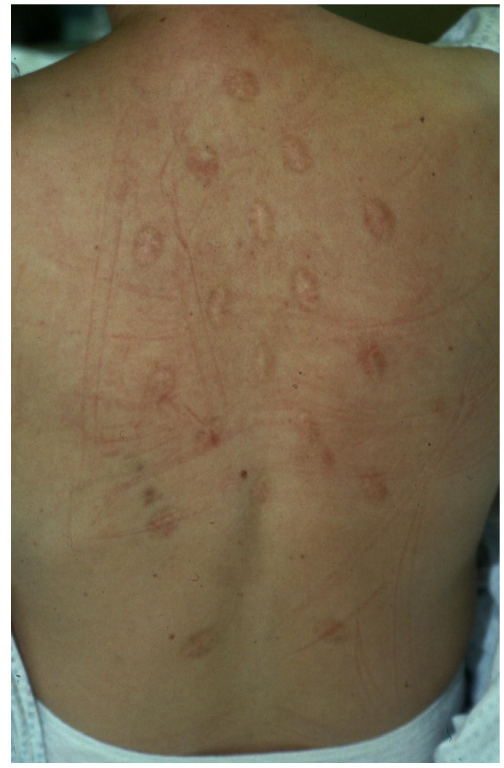 cigarette scars on skin PDF) Cigarette burns in forensic medicine