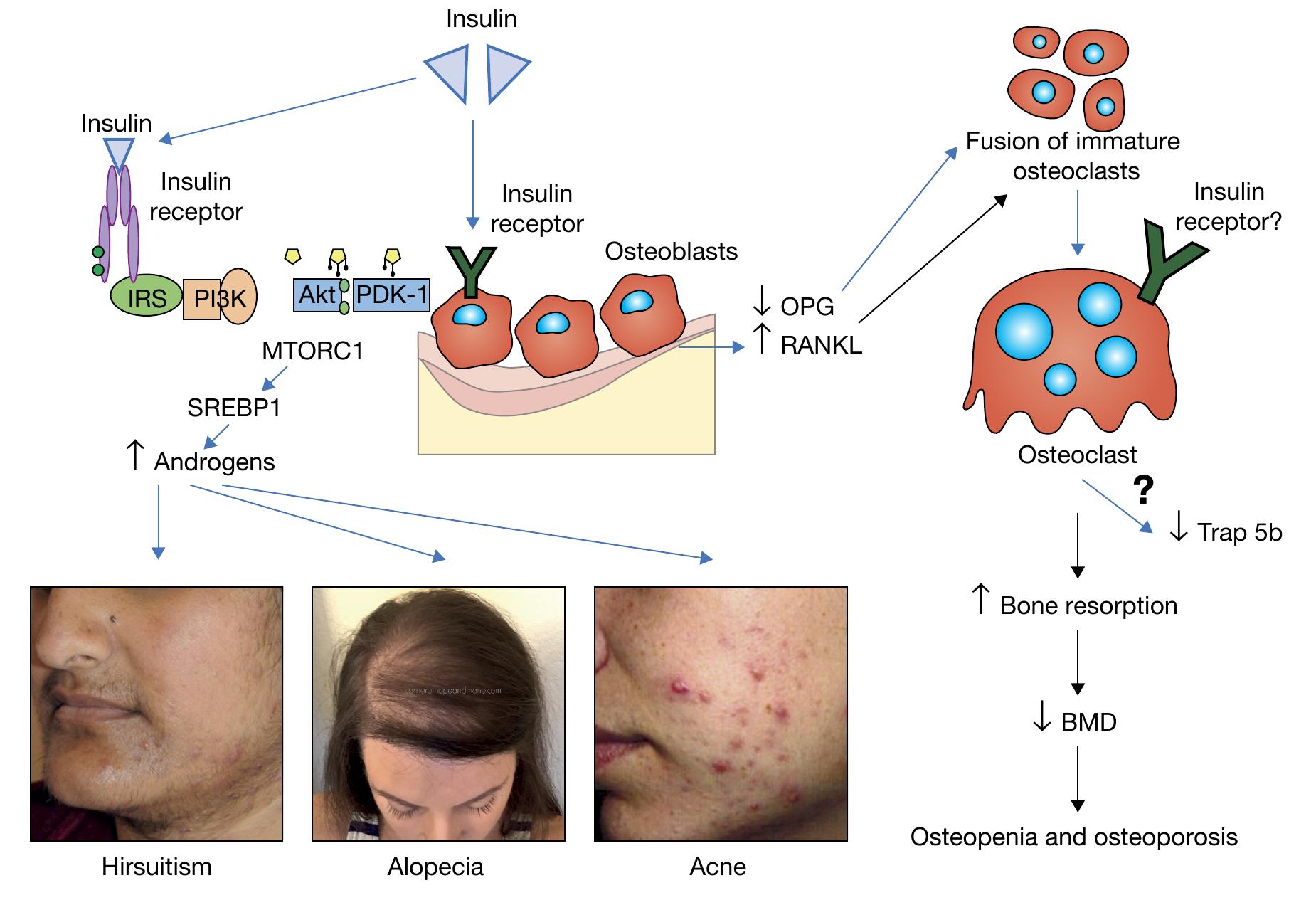 (PDF) Hormonal alterations in PCOS and its influence on bone metabolism