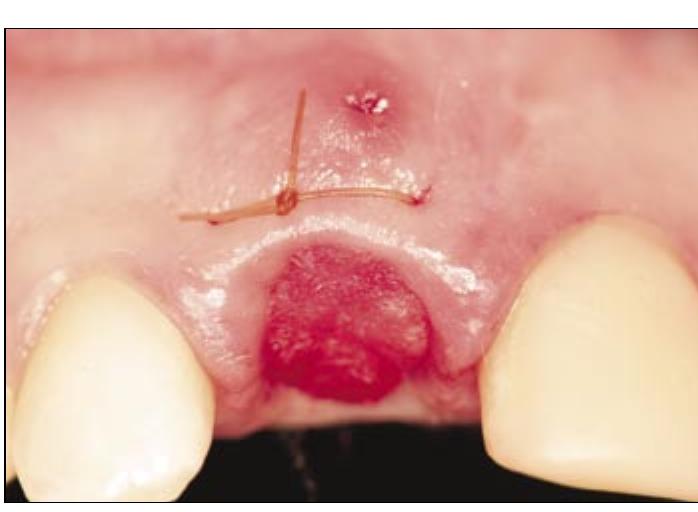 Figure 10 - Extraction Defect: Assessment, Classification