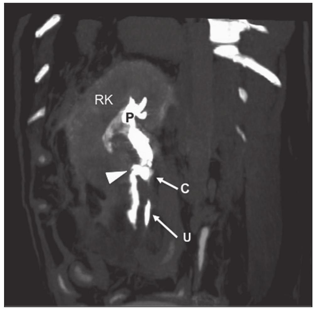 (PDF) Ultrasound-guided percutaneous antegrade pyelography with ...