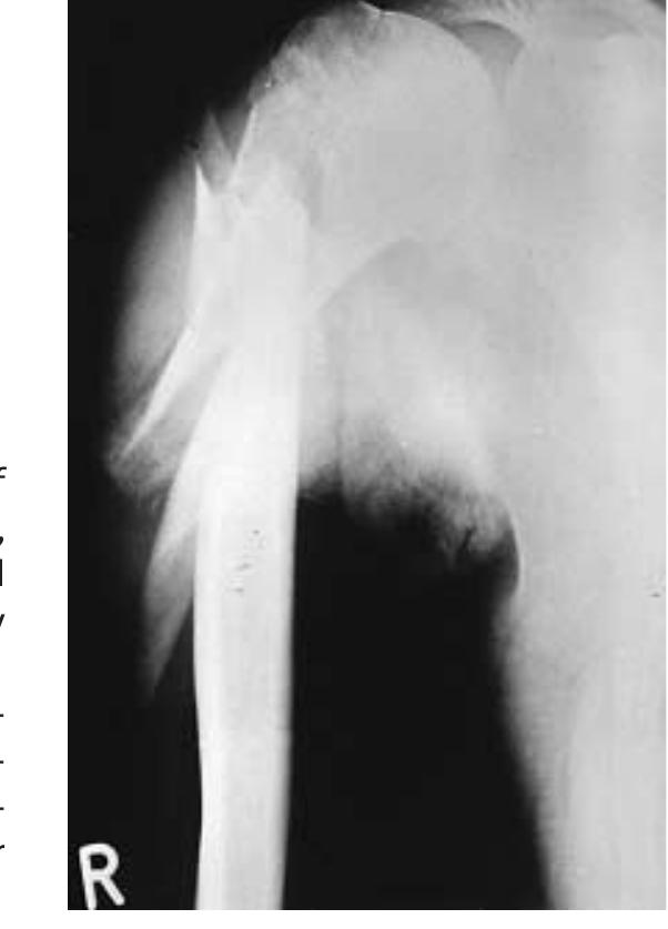 Figure 1 - from Intramedullary Wiring of Proximal Humerus