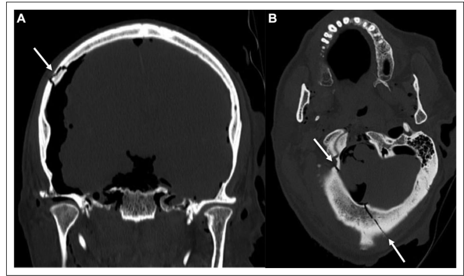 Postmortem Trauma (PDF) Postmortem CT in Trauma: An Overview