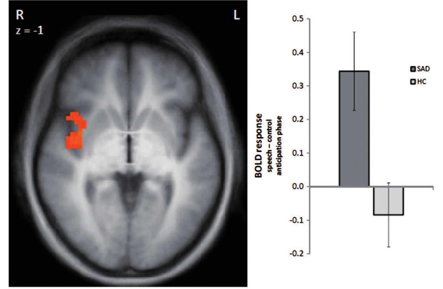 (PDF) Brain activation during anticipatory anxiety in social anxiety ...