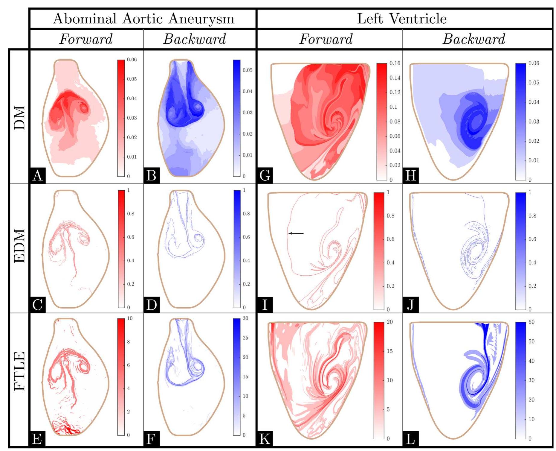 (PDF) Extracting Lagrangian coherent structures in cardiovascular flows ...