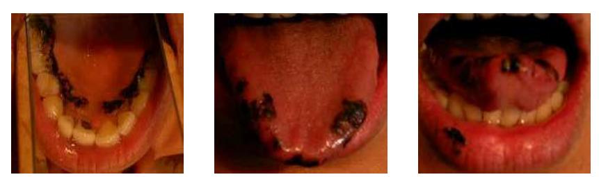 Figure 3: an apical post-alveolar [t] in [dasa]: Palatogram (left) and linguograms for Speaker F1. Palatal contact is behind the alveolar ridge. . The tongue tip and the rim are used. 