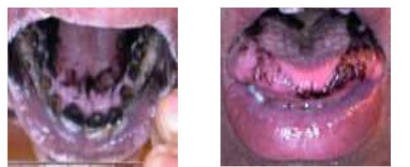 Figure 4. [gaq’a} Palatogram (left) and linguogram for Speaker M2. Palatal contact is behind the alveolar ridge. We notice a lesser degree of subapical contact. 