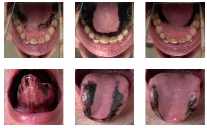 curling back behind the alveolar region with the underside of the tongue when it is preceded and followed by back or and low vowels, i.e. [u] or [a].  Figure 5. Palatograms (first row) and linguograms (second row) of Corpus 2 test words as produced by the speaker M5 in different vocalic contexts: [a] (first column), [i] (second column), [u] (third column). Place of articulation as well as lingual contact vary according to different vocalic contexts. The high front vowel is realized further forward and with only the tip and the rim of the tongue without subapical contact. 
