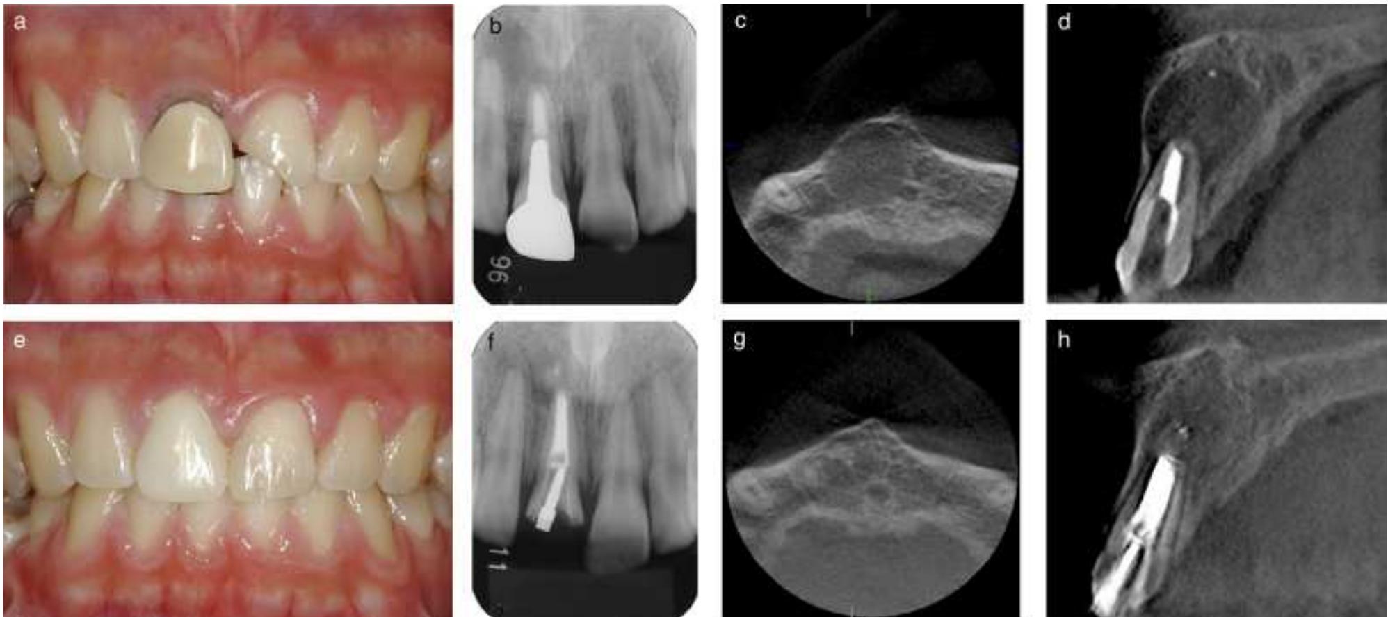 Rarefaction Radiograph (PDF) Optimal use of photography, radiography and micro computed ...