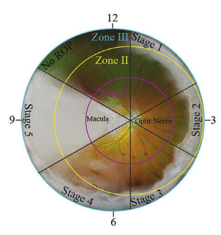 Vascular Ridge Rop (PDF) The effects of preterm birth on visual development