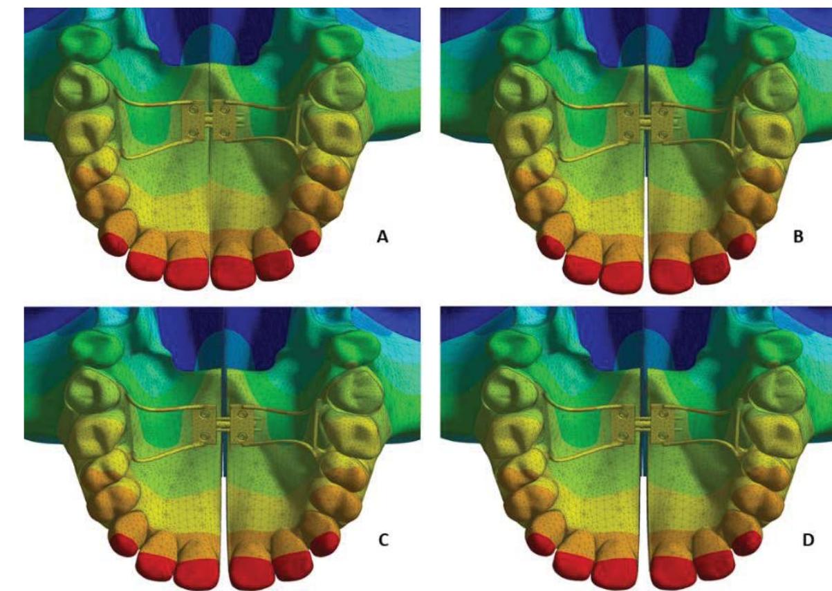 Alatal Point (PDF) Stress distribution and displacement of maxilla in micro-implant ...