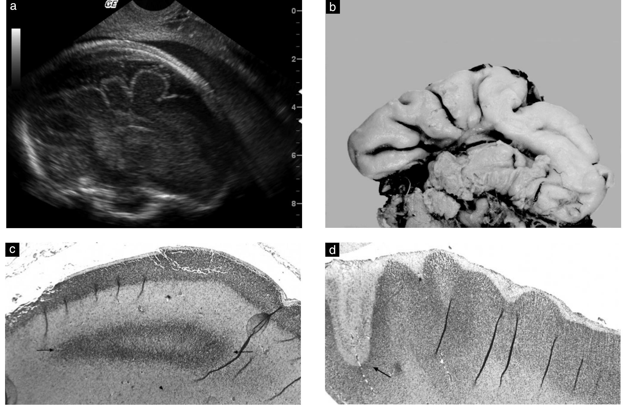 (PDF) Prenatal diagnosis of malformations of cortical development by ...