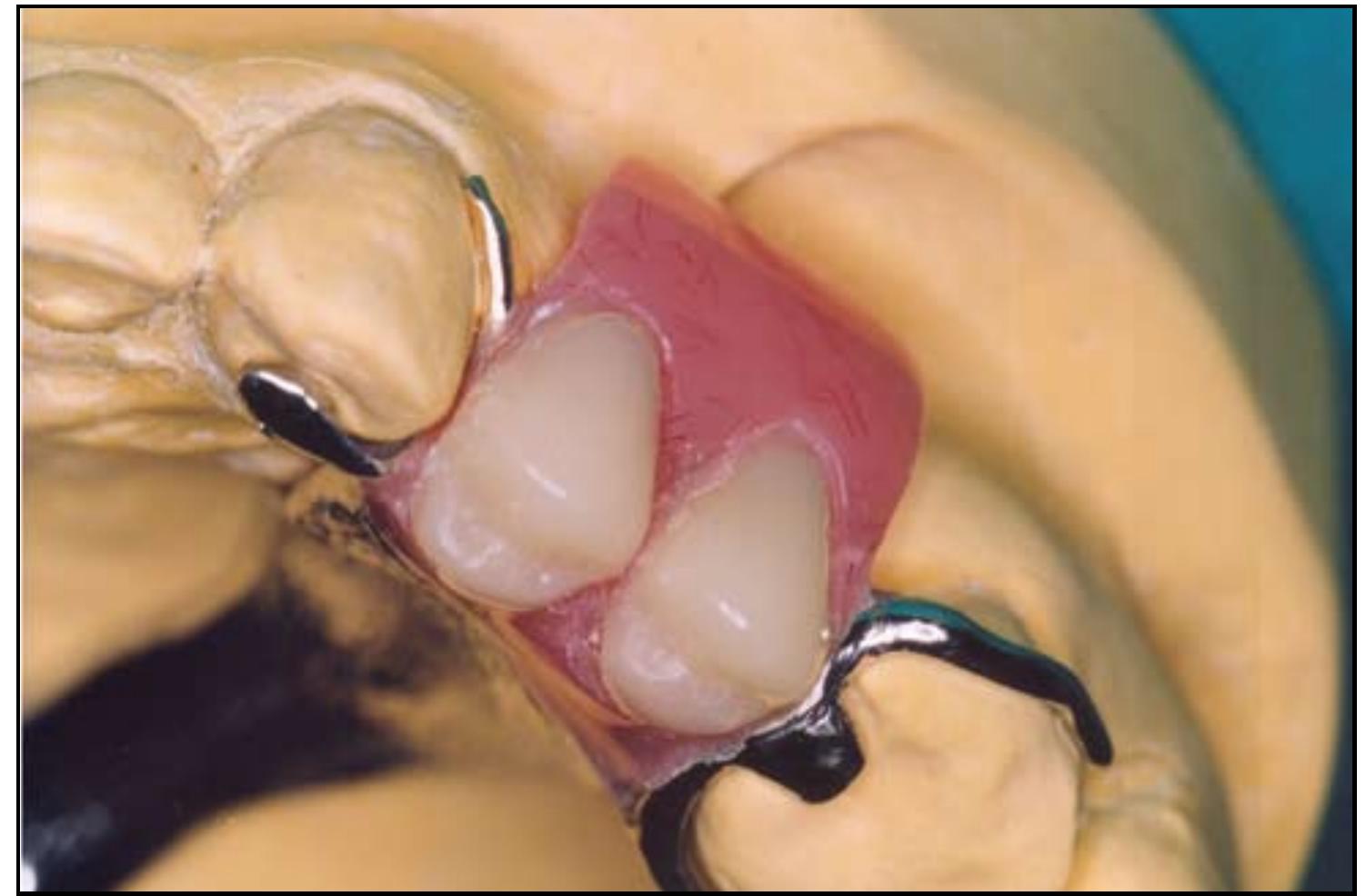 Figure 1 - from Aesthetic clasp design for removable partial