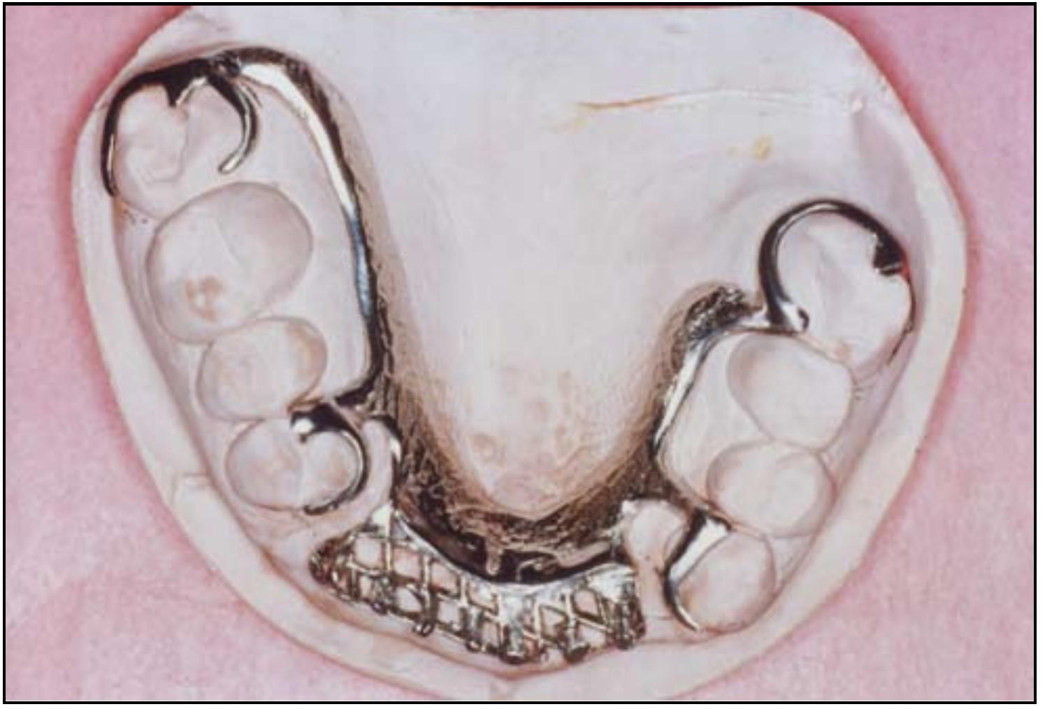 Figure 8 - from Aesthetic clasp design for removable partial