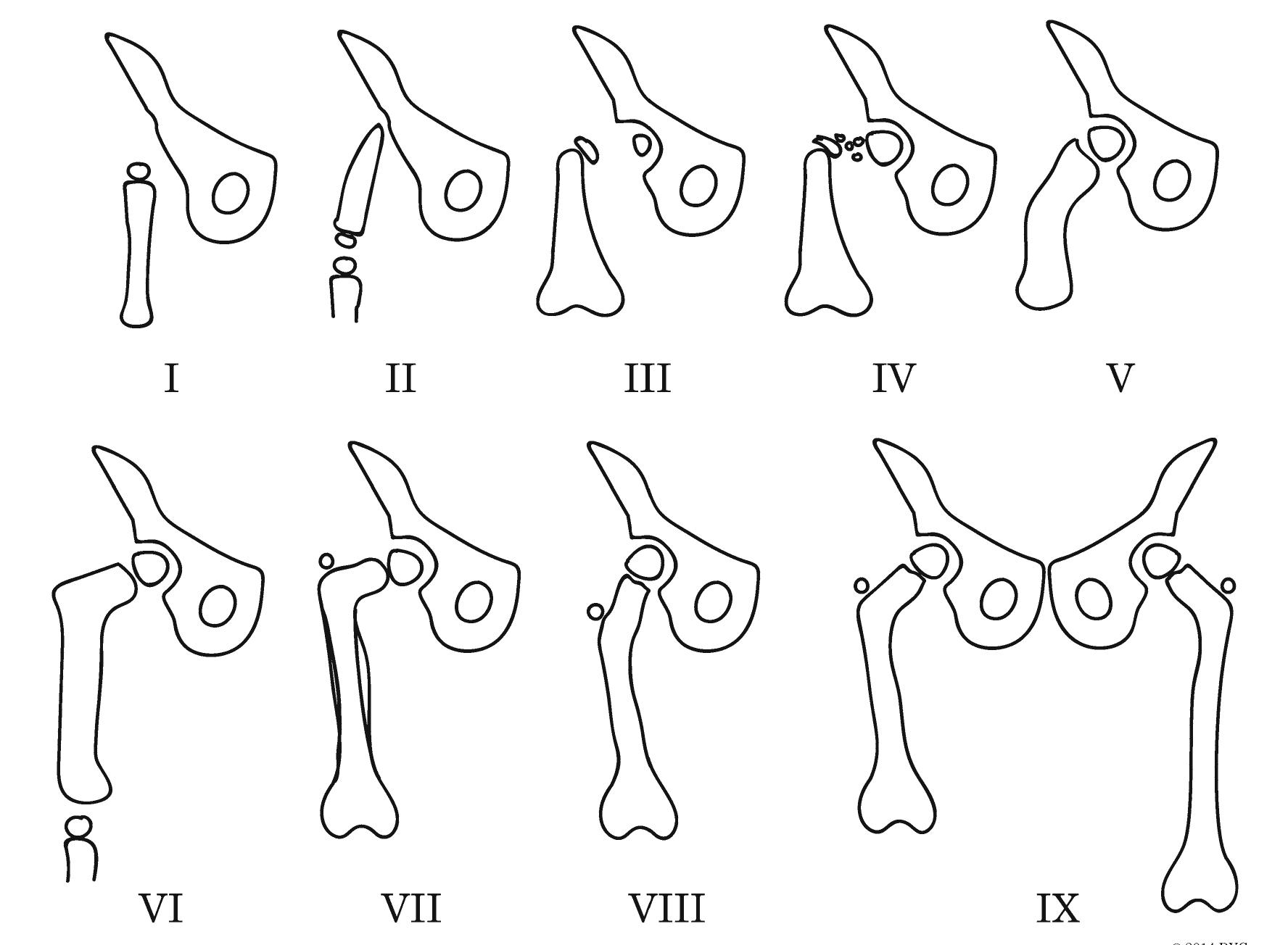 Figure 5 - from Congenital Femoral Deficiency Reconstruction