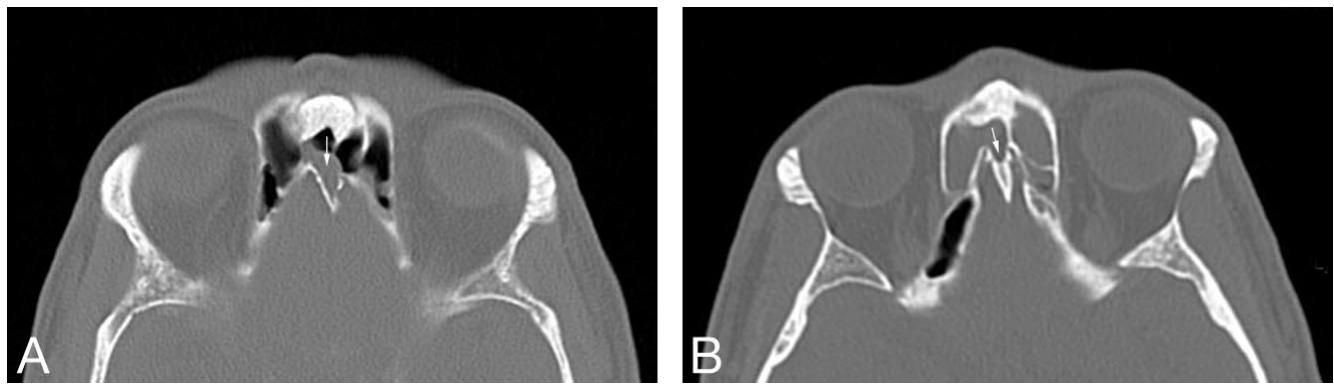 A, coronal ct scan of the paranasal sinuses in a 45-year-old