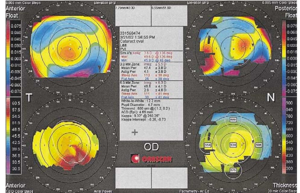 (cua) anterior and posterior elevation, axial power, and