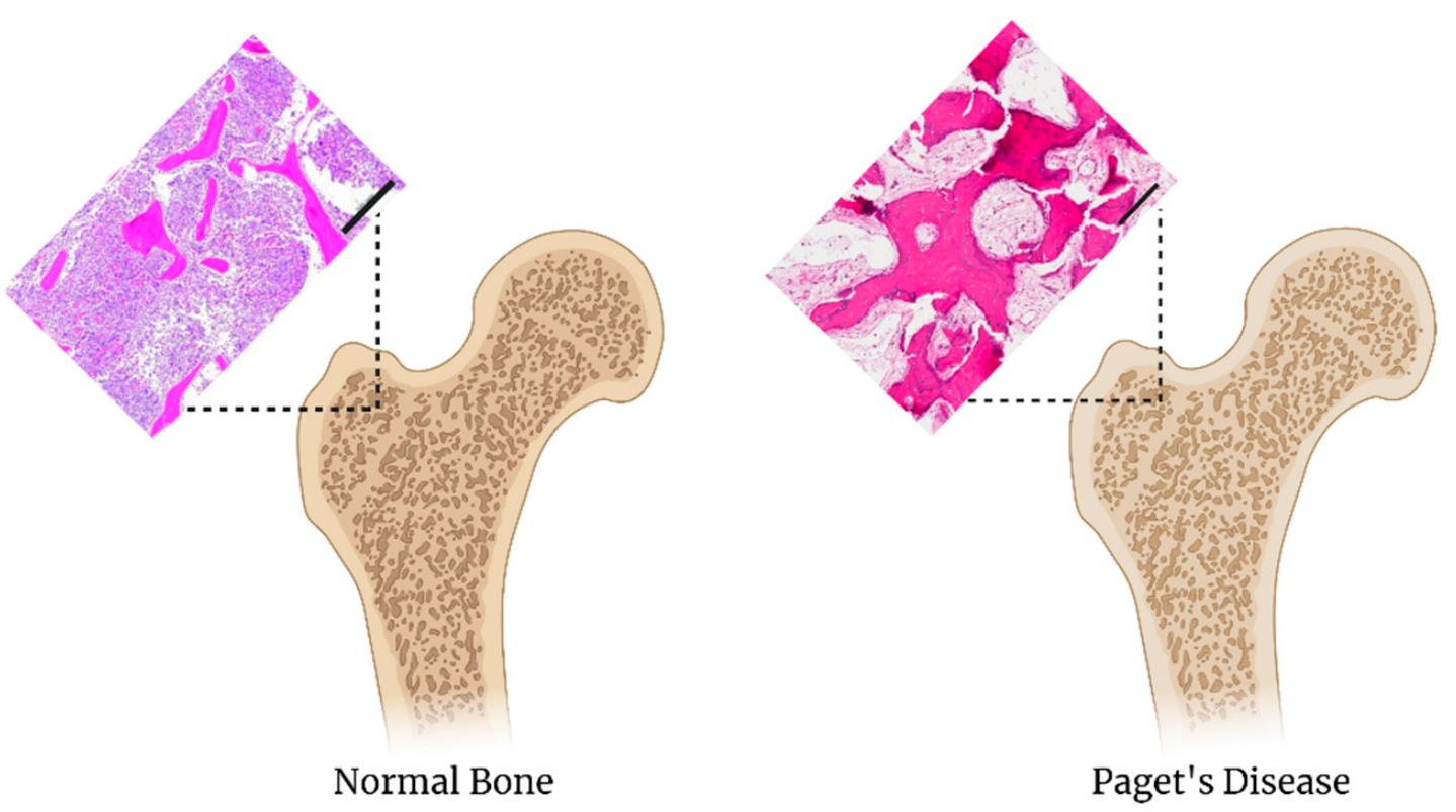 Comparison of normal bone to paget’s disease the h&e stain