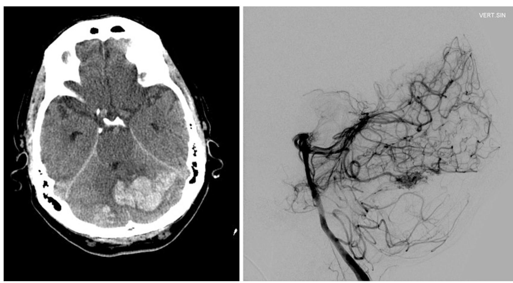 Figure 5 - from Surgery of Posterior Fossa AVM