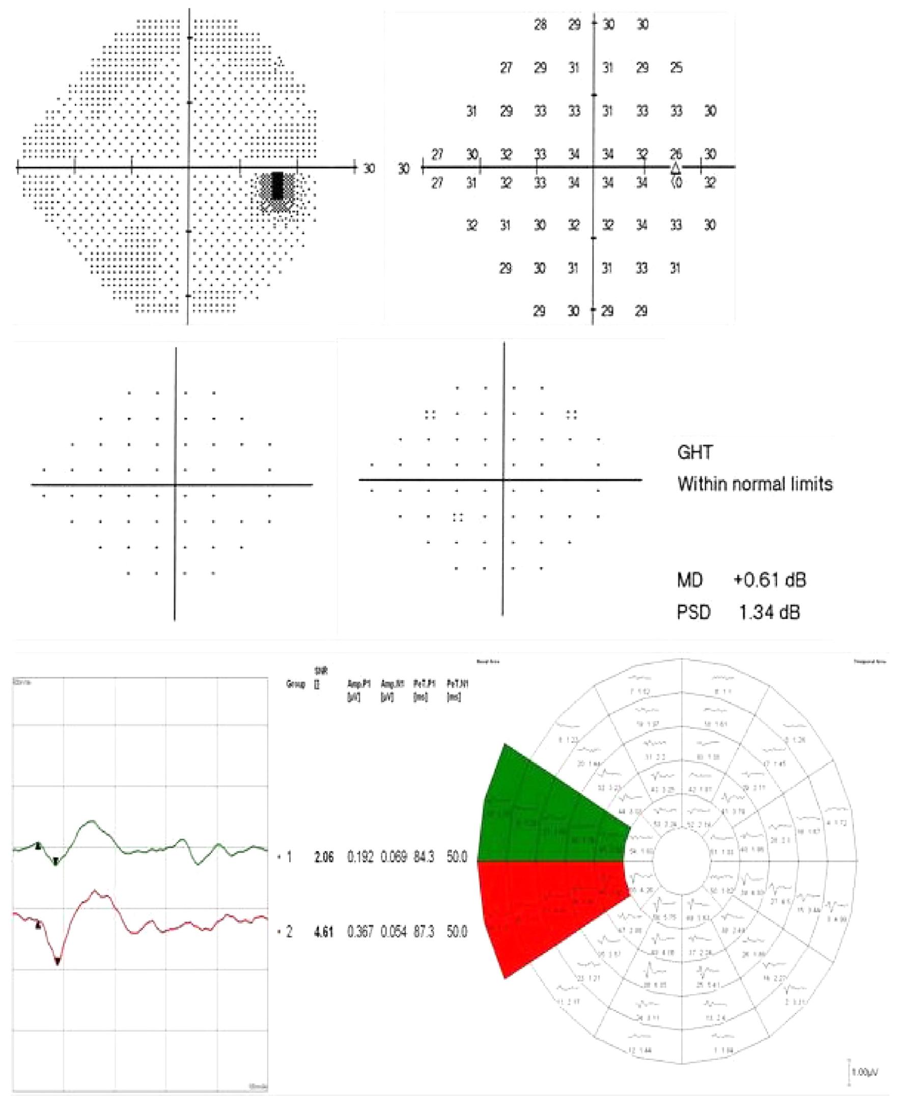(PDF) The role of hemifield sector analysis in multifocal visual evoked ...