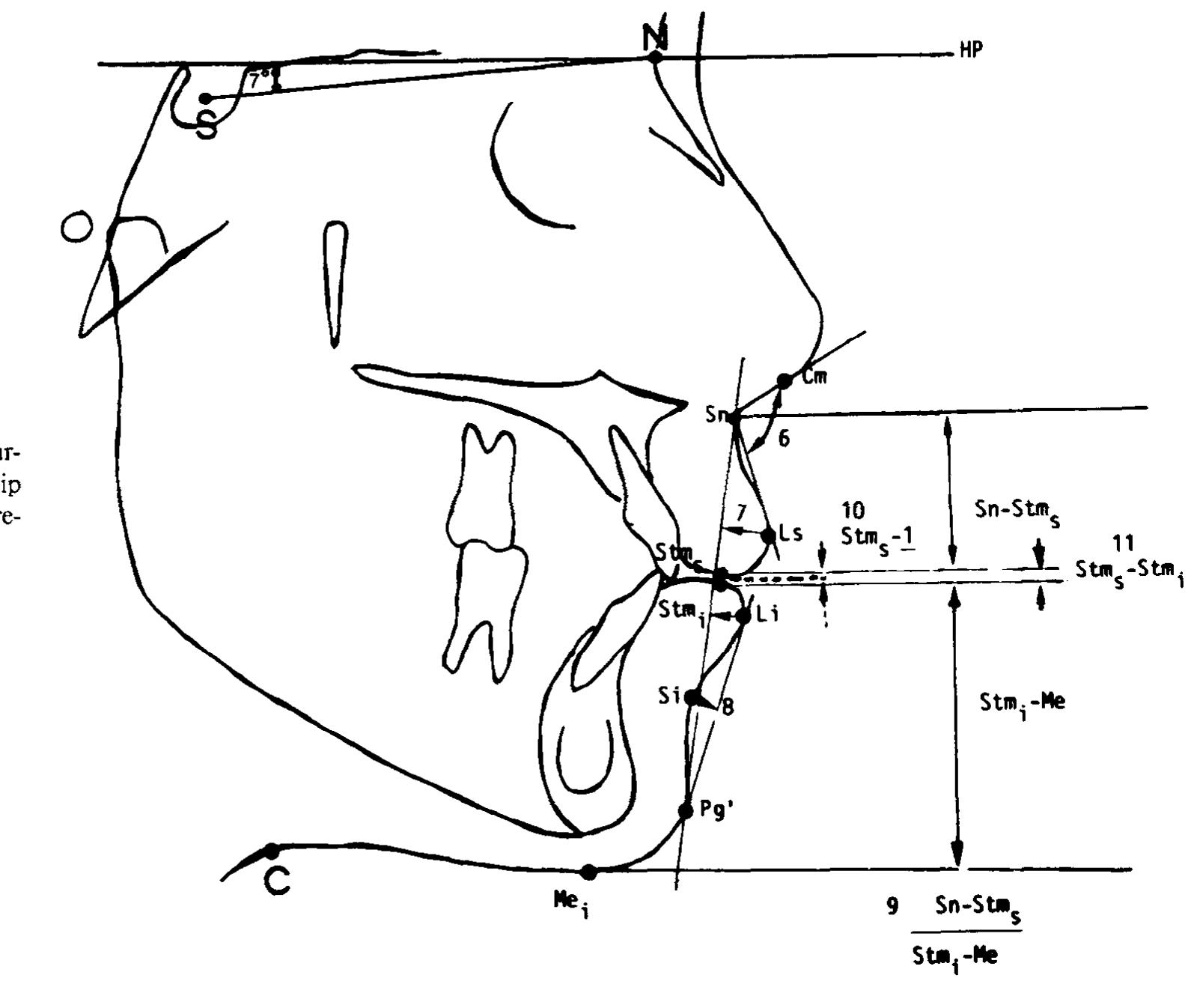 (PDF) Soft-tissue cephalometric norms in Chinese adults with esthetic ...