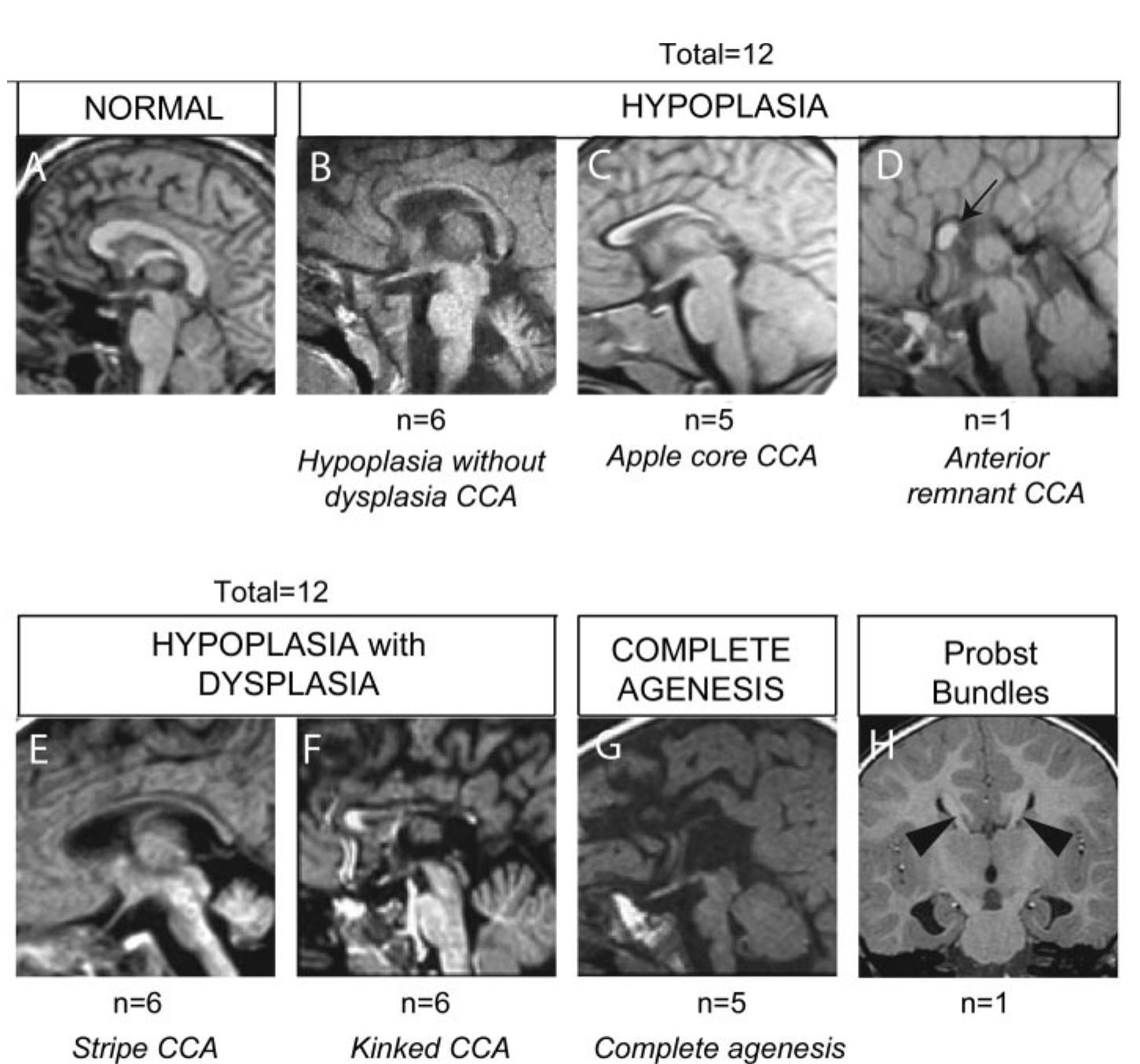 Midline sagittal mri representing the spectrum of corpus