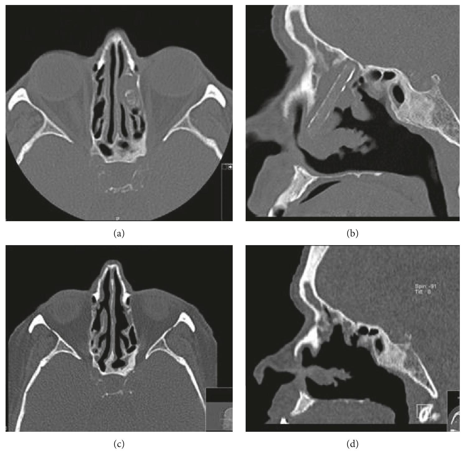 Ficure 1: (a, b) axial and sagittal cuts of a paranasal ct