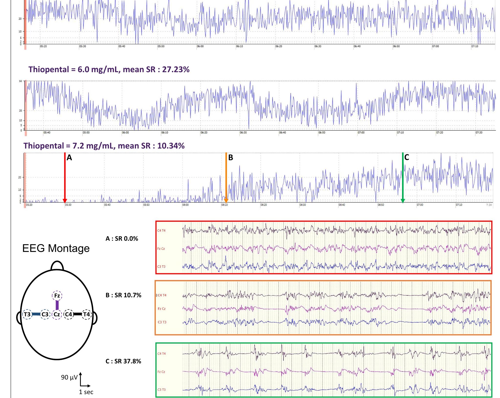 Suppression Ration Example Figure 1 - from How to monitor thiopental administration in