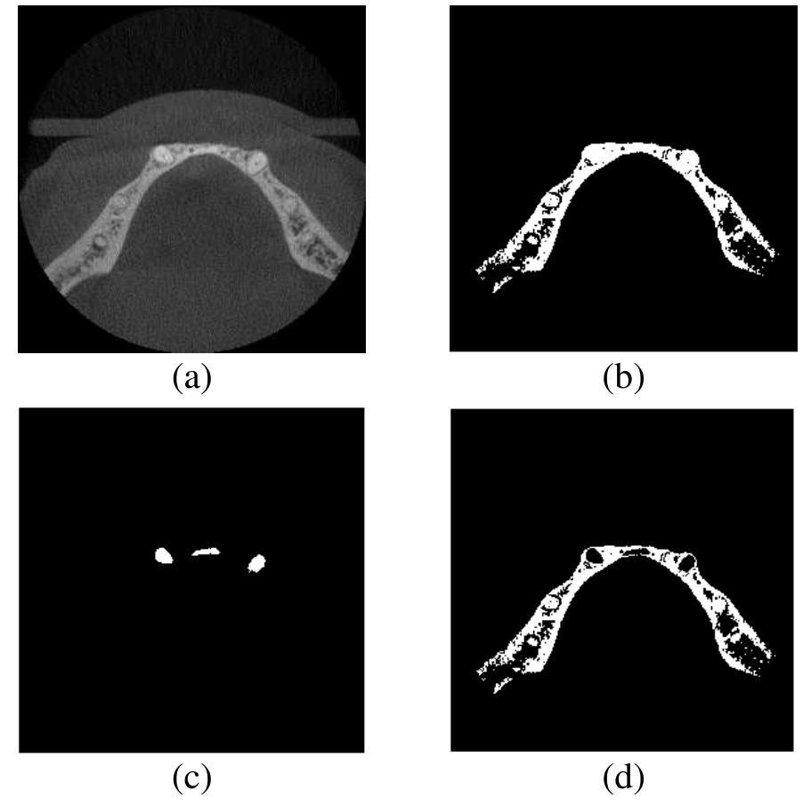 Figure 6 - Automatic Segmentation of Mandibular Cortical