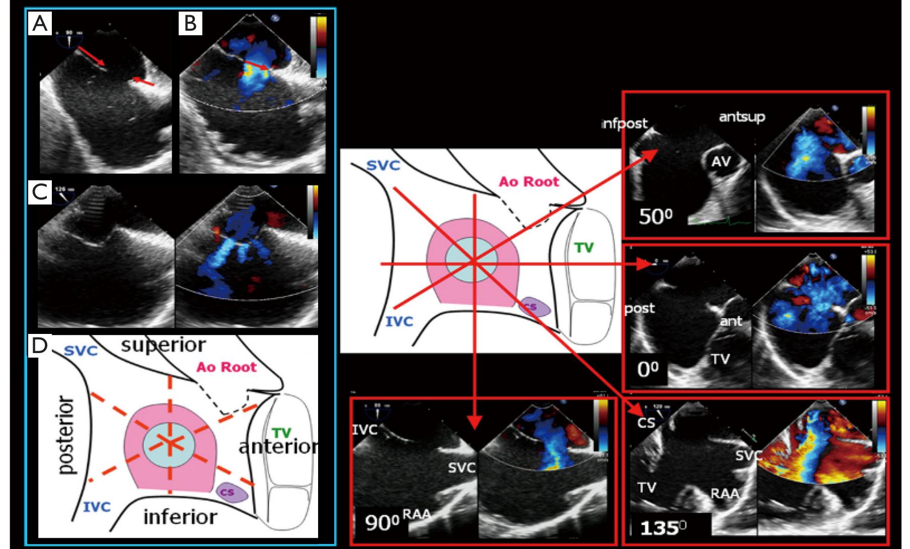 Ivc Asd Rim (PDF) Echocardiography guidance of atrial septal defect closure