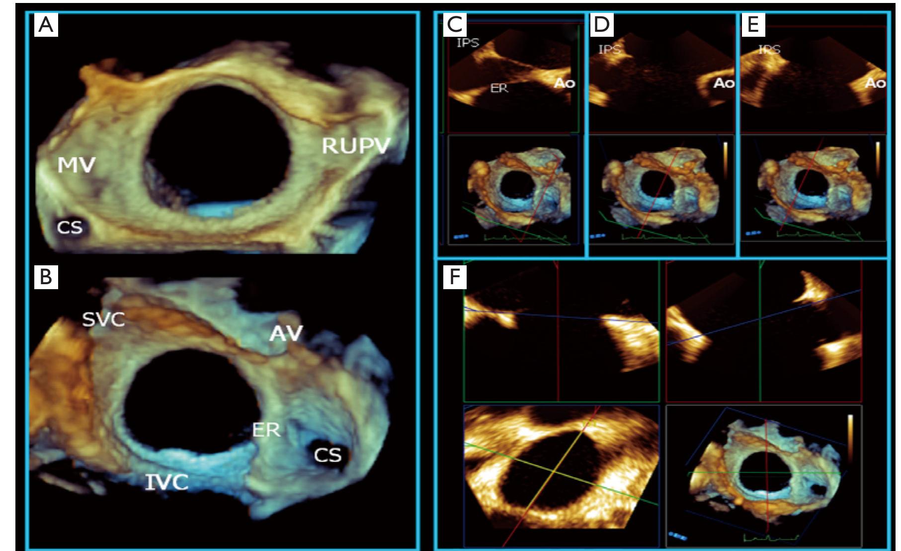 Ivc Asd Rim (PDF) Echocardiography guidance of atrial septal defect closure