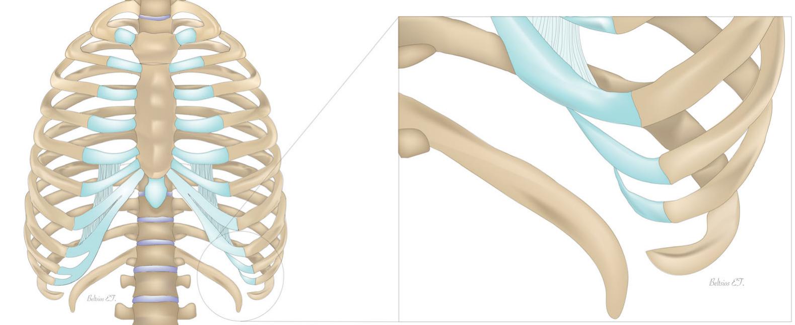 (PDF) Surgical Management of the Slipping Rib Syndrome