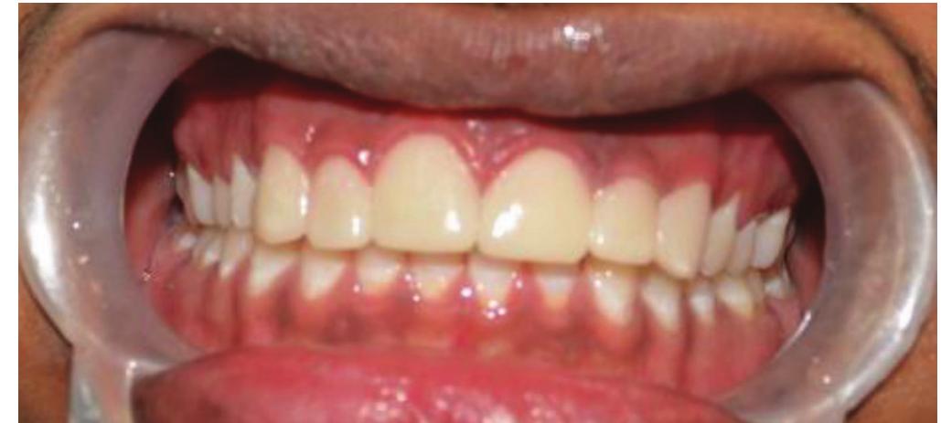 Figure 3 - from Management of Spacing in Maxillary Anterior